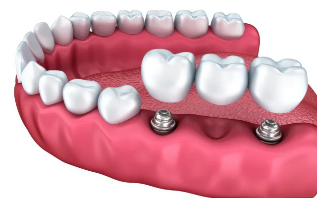 Имплант или мост: честный разбор от врача, который ежедневно ставит и то, и другое
