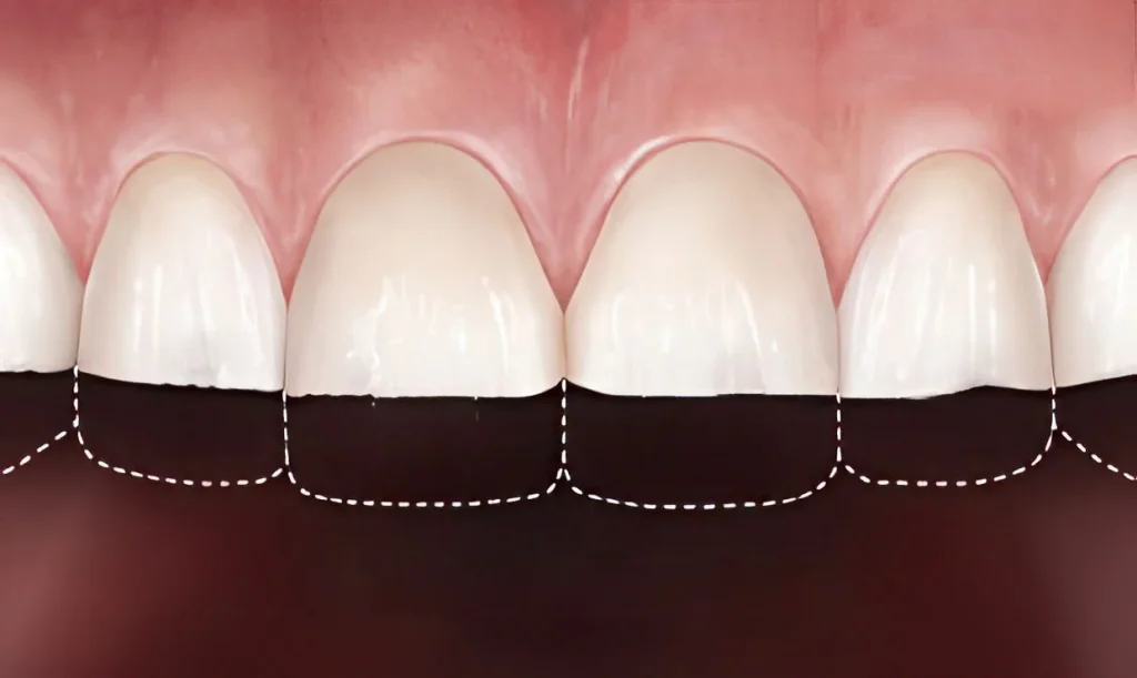 Стираемость зубов