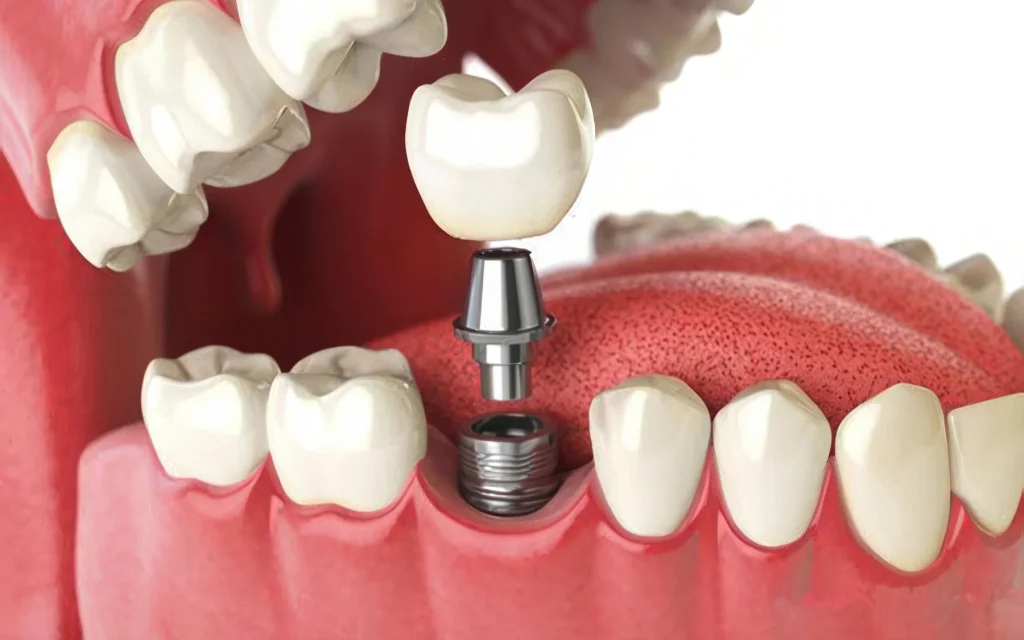 Имплантация зубов