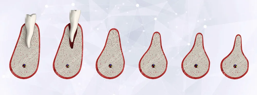 Как происходит атрофия костной ткани