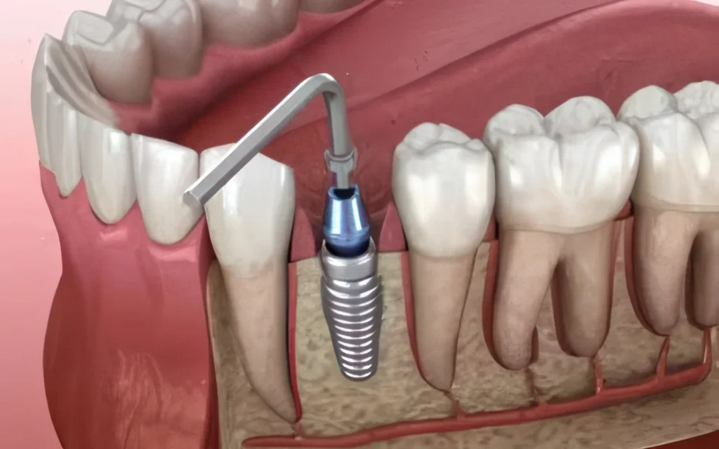 Установка импланта