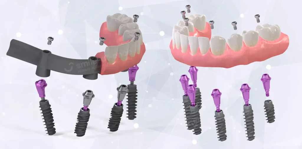 Pro Arch от Straumann на 4 и на 6 имплантах