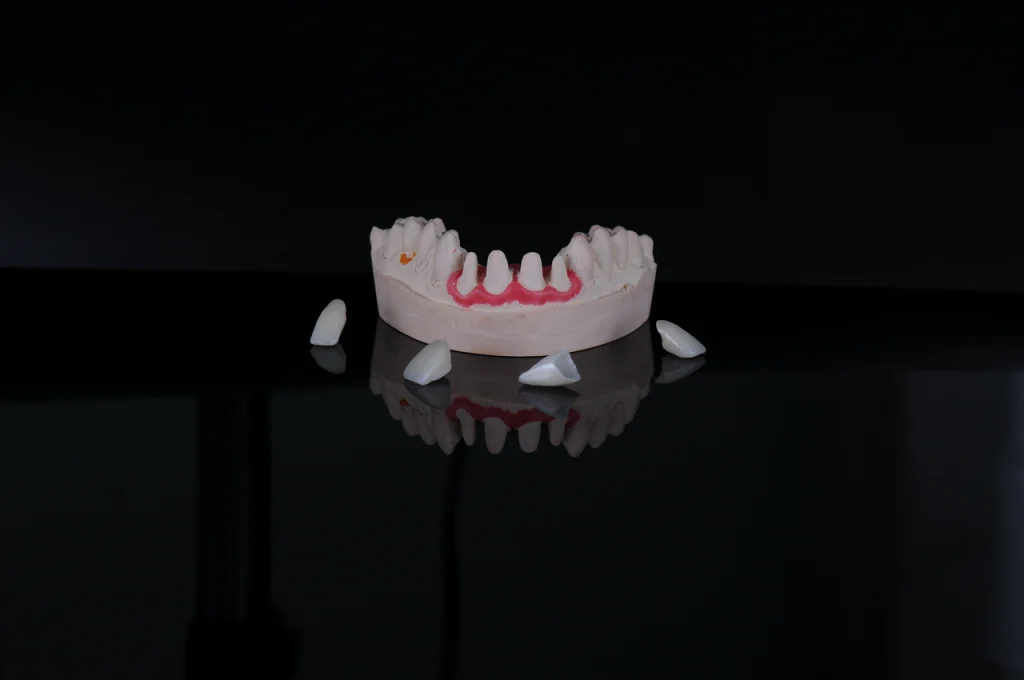 финальный лабораторный этап – на фото видно гипсовую модель с препарированными зубами и рядом расположенными готовыми керамическими тонкими коронками