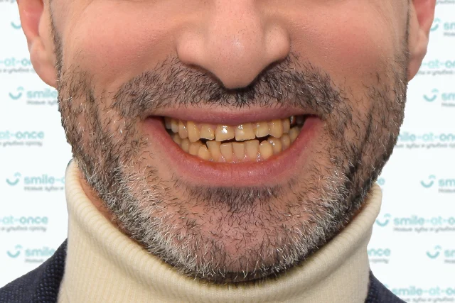 До — Комплекс для красивой улыбки – виниры, имплантация и коронки