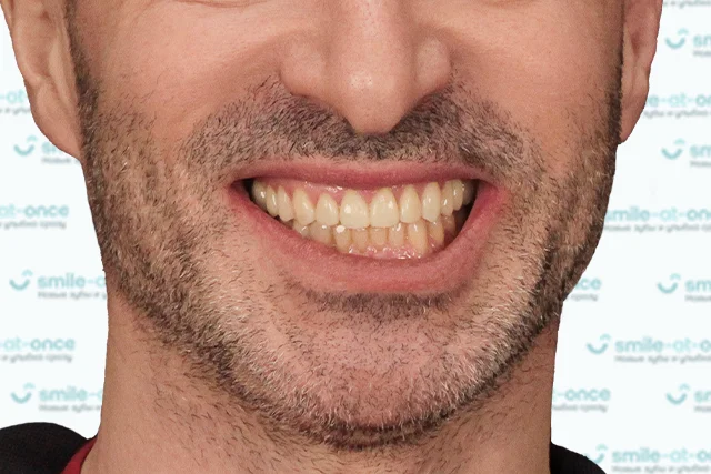 После — Комплекс для красивой улыбки – виниры, имплантация и коронки