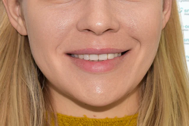 До — Виниры и имплантация жевательных зубов