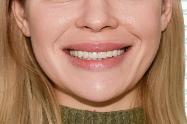 После — Виниры и имплантация жевательных зубов