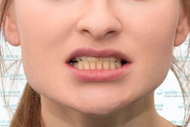 До — Красивая улыбка и здоровые зубы: виниры и одиночная имплантация