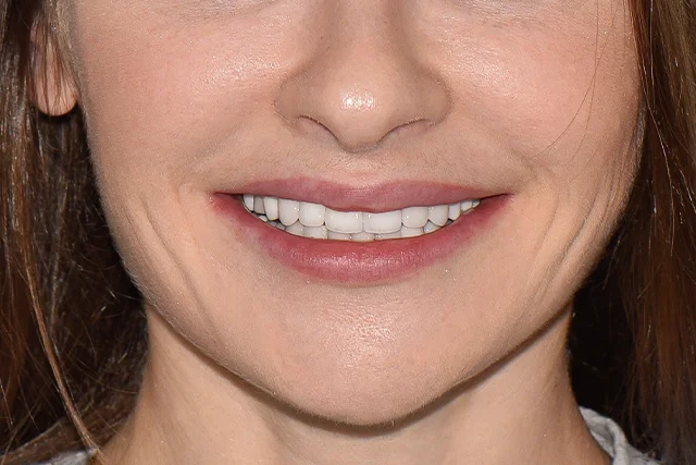 После — Красивая улыбка и здоровые зубы: виниры и одиночная имплантация