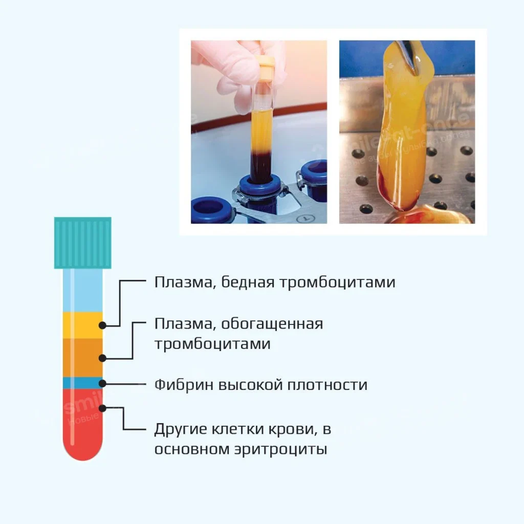 Рисунок - создание PRF-мембраны для имплантации и плазмолифтинга