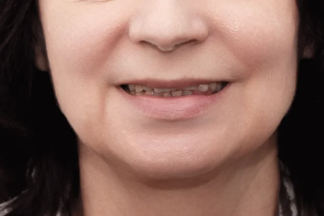 До — Имплантация all-on-6 и виниры на зубы