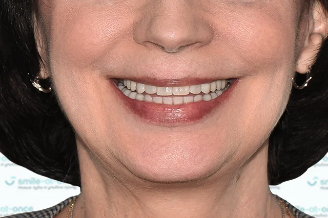 После — Имплантация all-on-6 и виниры на зубы