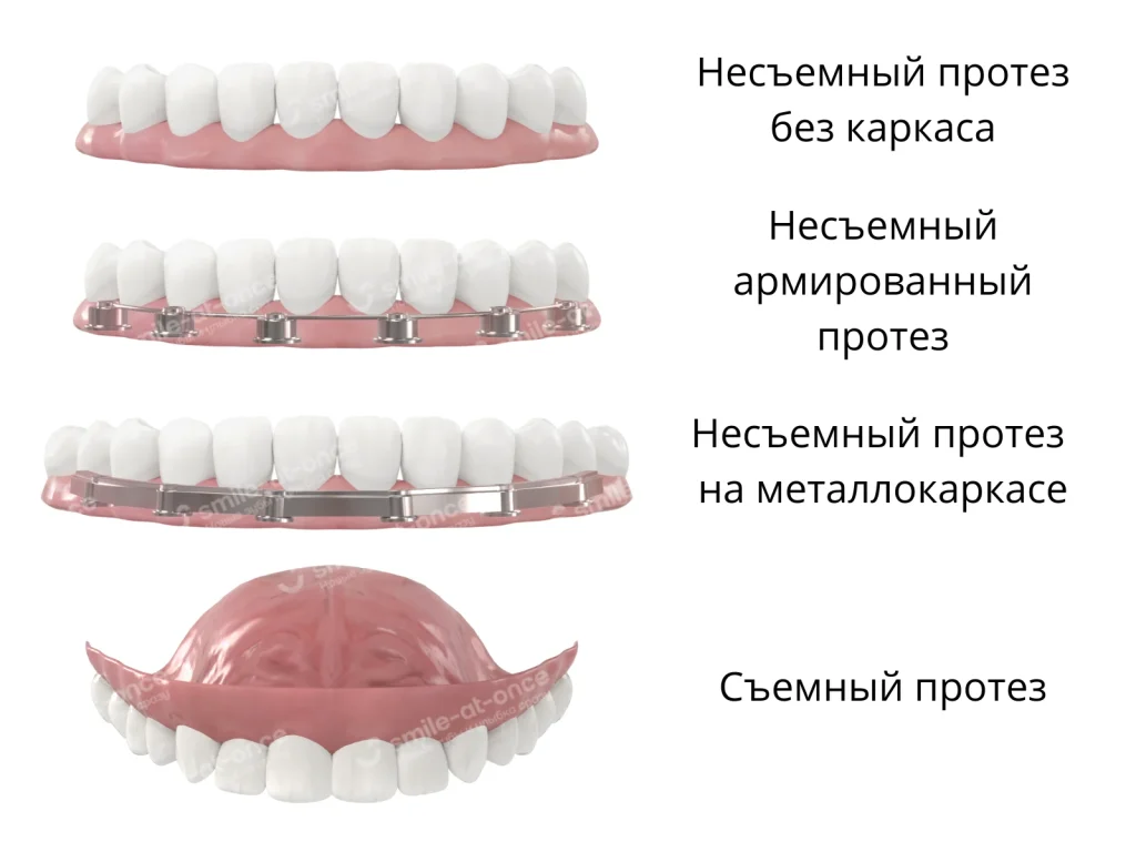 Виды адаптационных протезов после имплантации All-on-6