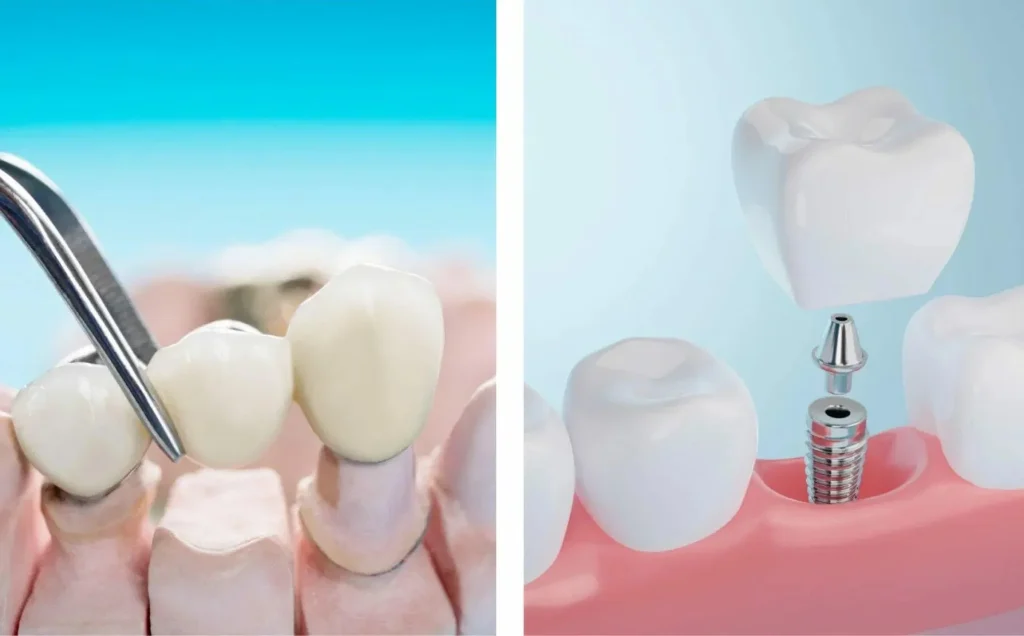 Мост на зубы и коронка на импланте