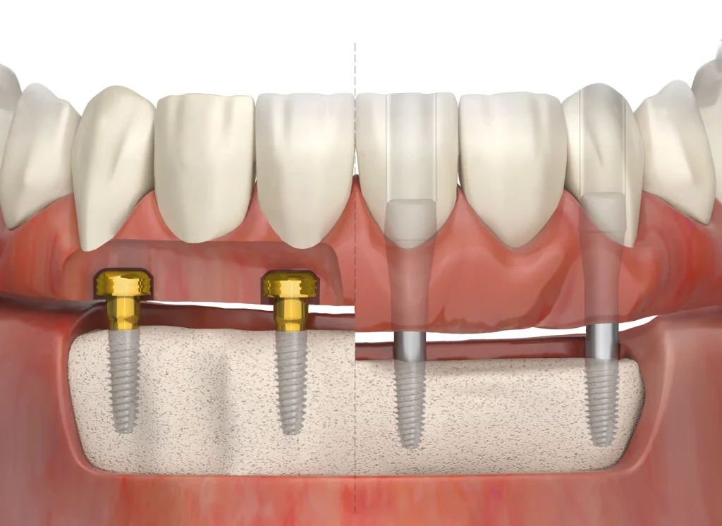 Съёмные протезы с замковым креплением: кому это действительно подходит