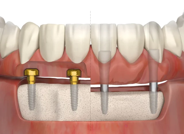 Съёмные протезы с замковым креплением: кому это действительно подходит
