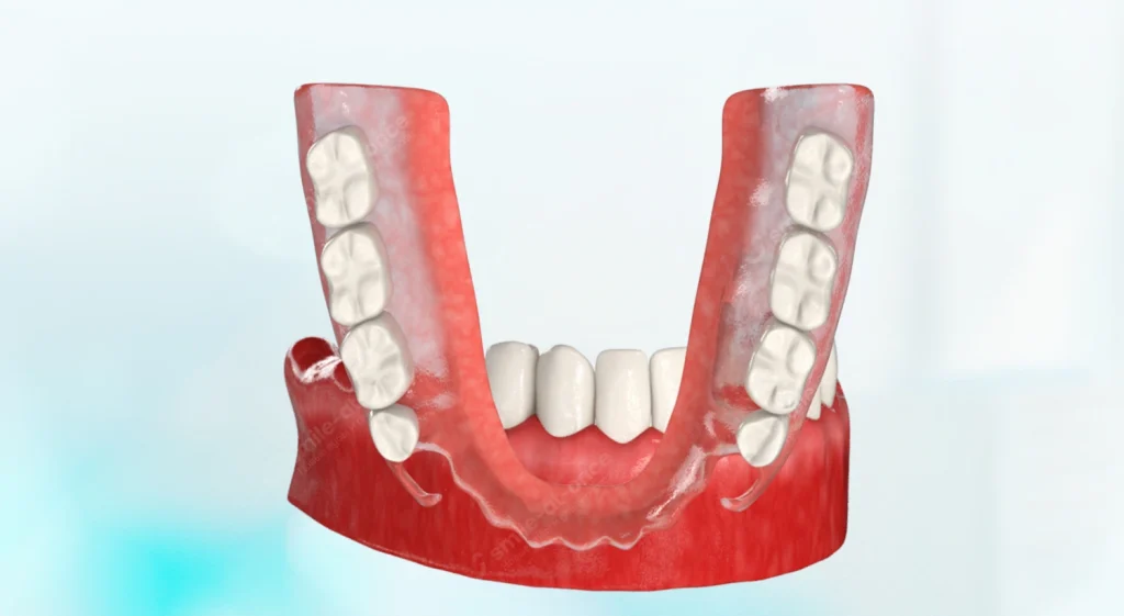 Протез Acry-free