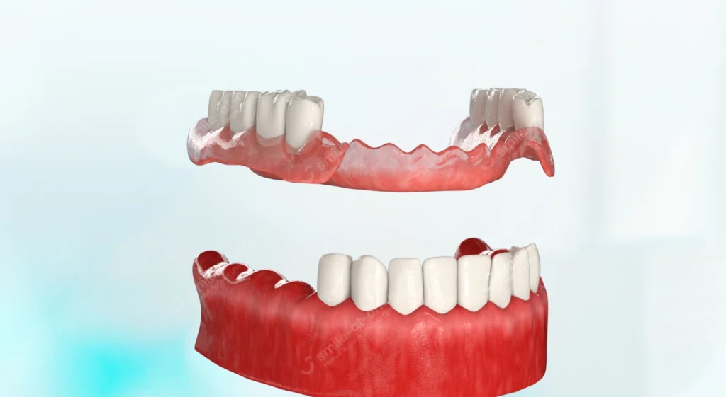 Протез Acry-free