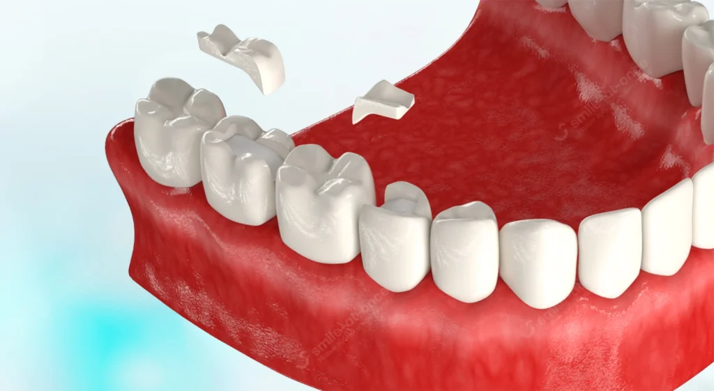 Вкладки в зубы